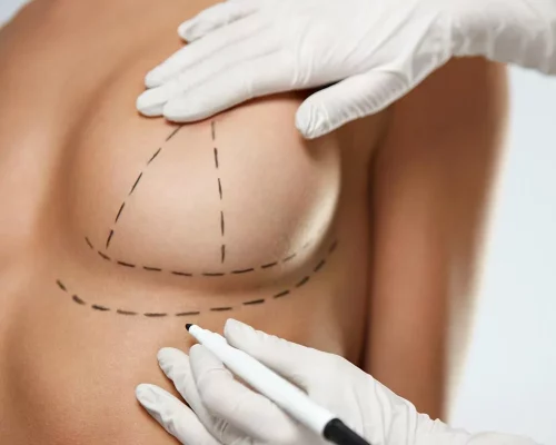 aesthetic surgery breast marks