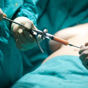 Doctor filling liposuction syringe after he done liposuction. Now the fat is ready to be injected into the breast, which is cut off due to cancer.